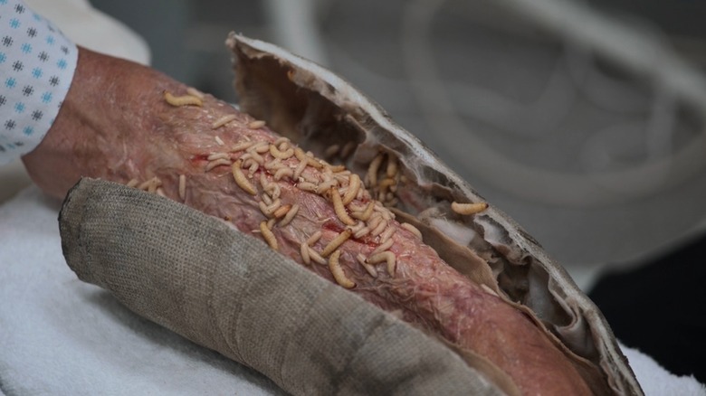Maggots on arm after cast removal on The Pitt