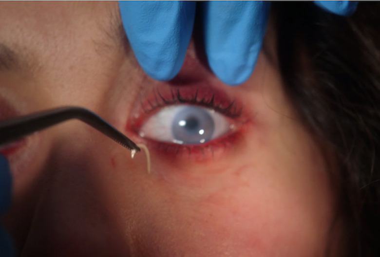 911-eyeball-worm-4x03